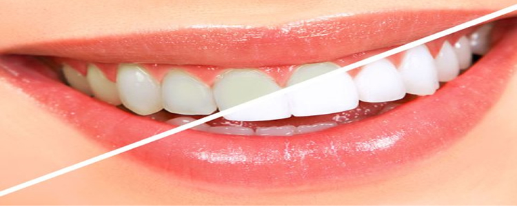 Teeth Whitening