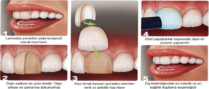 Laminate Veneers
